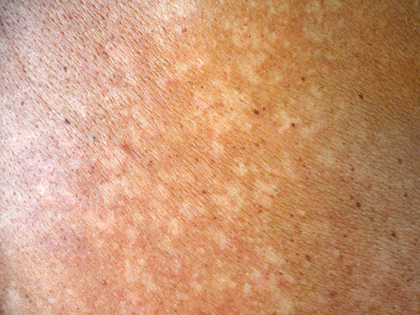Tinea versicolor